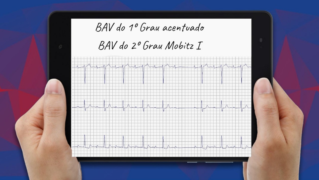 BAV 1º GRAU ACENTUADO & BAV 2º GRAU TIPO I - TME - Telemedicina ...