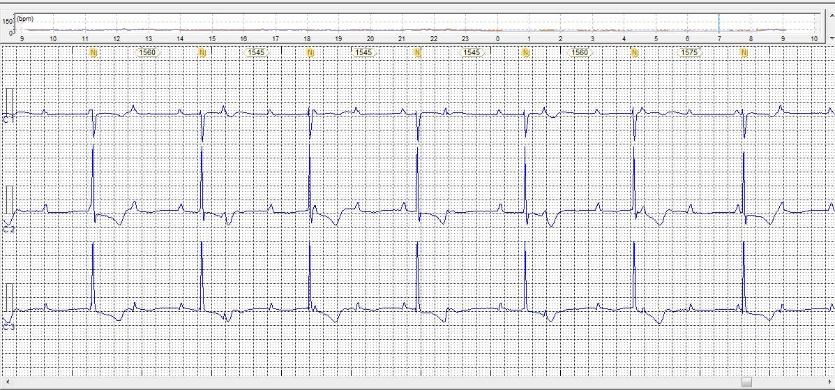 Bloqueio Atrioventricular Total (BAVT) Com QRS Estreito - TME ...