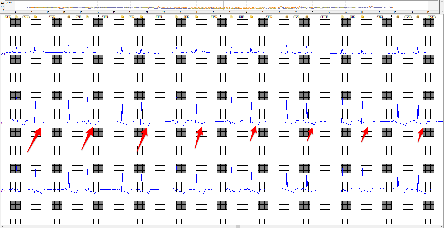 bigeminismo ventricular